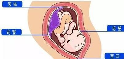 胎盘是前壁好, 还是后壁好 在哪种情况下, 孕妈妈生孩子时生得比较快呢