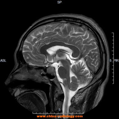影联网 MRI病例 男,49 左侧肢体麻木 