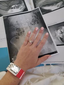 一名女子分享了噩梦中吞下订婚戒指后令人震惊的x光照片