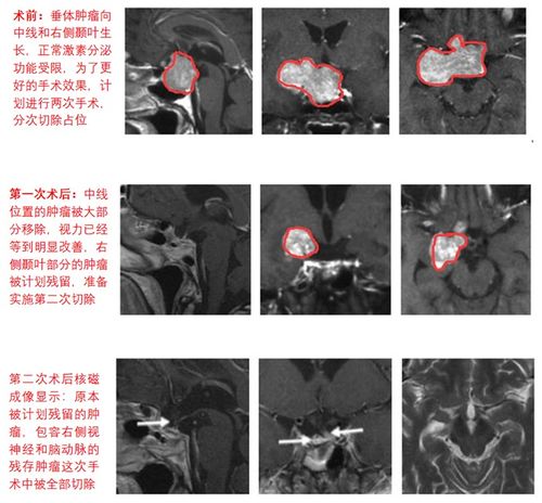 垂体瘤治疗方法,内镜微创案例两则