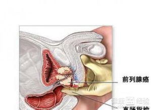 患前列腺癌的原因