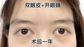 磨骨术后张不开嘴 做完下颌角和颧骨后,下巴麻木没知觉 削骨术的那些后遗症