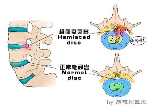 年纪轻轻腰不行了,推拿按摩一下 风险很大