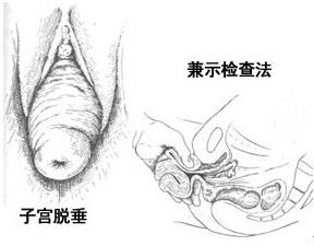 子宫下垂有什么症状，子宫下垂有什么症状有什么危害