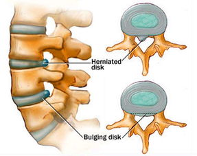 谁知道腰椎间盘突出症的治疗方法是什么?