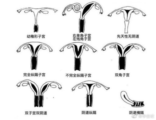 一般子宫有什么问题不能怀孕 子宫畸形的种类有哪些