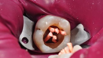 哺乳期可以杀牙神经补牙吗
