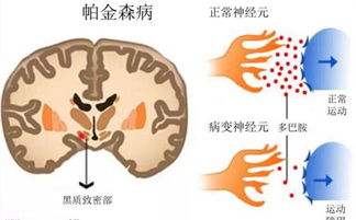 帕金森会影响正常生活吗(帕金森会导致性功能障碍吗?)