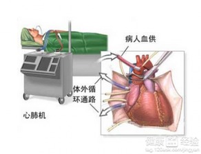 心脏搭桥手术危险吗(73岁做心脏搭桥手术危险吗)