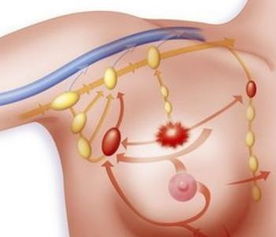 乳腺结节需要手术吗(bi-rads3类乳腺结节需要手术吗)