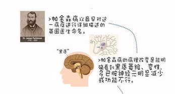 4月11日世界帕金森病日 潜伏期长 小医院易误诊 