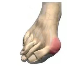 脚拇指外翻 女性高发病 经常脚疼的人该注意了