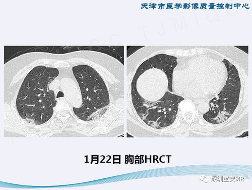 新型冠状病毒感染肺炎影像学表现 阶段性总结