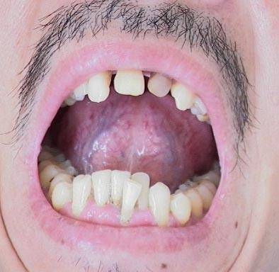 身体里有肿瘤,舌头上也会有表现 出现3种异象需小心