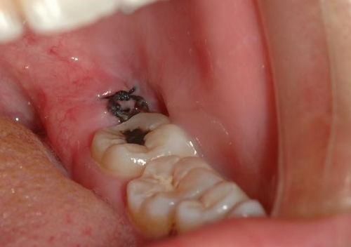 拔完智齿第十天, 有个牙洞正常吗 
