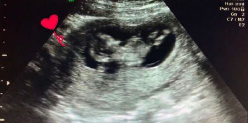 怀孕8个月胎儿b超图(女宝b超图典型的)