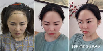 女生头发少怎样增加发量让头发变多 