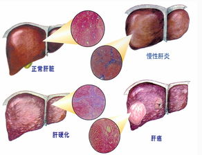 肝硬化失代償期飲食應如何注意?