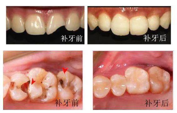 现代口腔补牙技术怎么样 贵嘛？