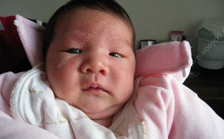 4个月婴儿湿疹起皮,四个月的宝宝脸上起皮怎么办是不是湿疹引起的