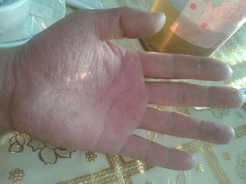 手癣的症状，手癣的具体症状是什么样的