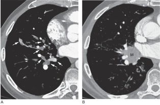 肺癌的影像学表现 上 多图 