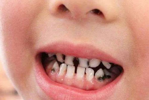 睡觉磨牙齿是缺钙吗吃什么药（睡觉磨牙齿是缺钙吗吃什么药最好）