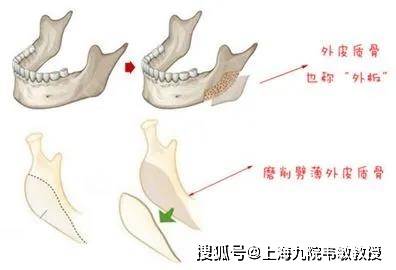 九院韦敏科普丨下颌骨截骨与劈外板有什么区别,应该注意的地方有哪些