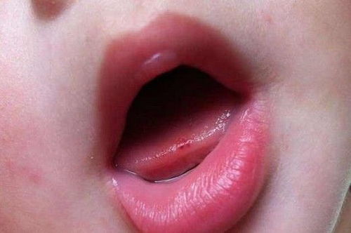 宝宝吃东西经常咬到舌头咬出血,不知这4个应急措施的宝妈亏大了 