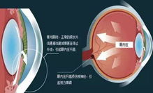 近视要防青光眼 青光眼是近视眼引发的比较严重的并发症之一