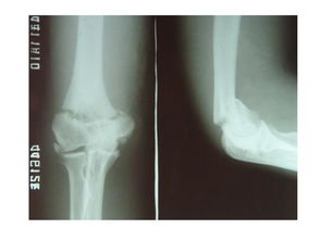 肘关节骨化性肌炎再骨折 请教手术方案 米粒分享网 Mi6fx Com