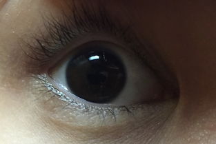 右眼瞳孔上有透明物体,而且只是右眼,并且时不时会疼,导致不停眨眼 