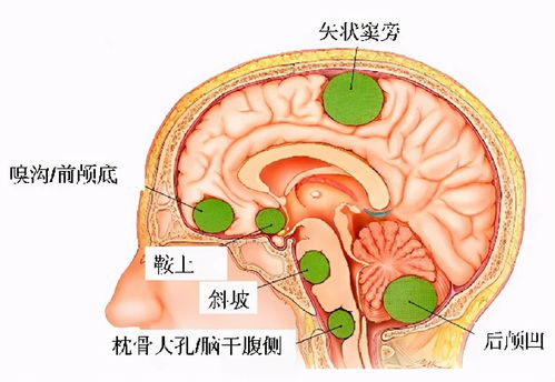 听力下降 面部麻木,除了听神经瘤,还要警惕脑膜瘤可能