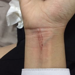 昨天晚上被猫抓伤了手腕 超级痛 整个手臂麻的 后面有点小肿 流血了 猫没有打过针 要不要打疫苗 