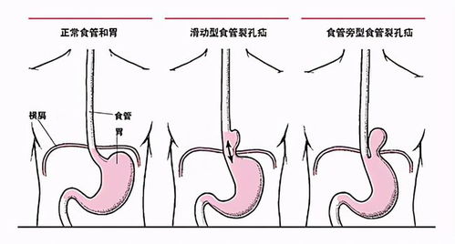 胃食管反流吃抑酸药不管用 这些情况可能要手术