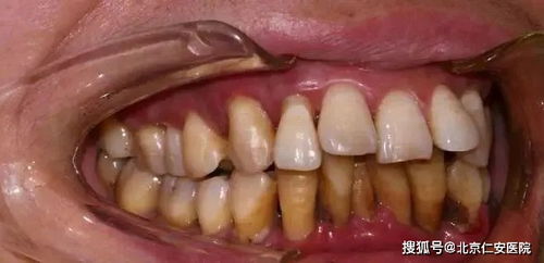 牙周炎可以严重到什么程度 看完好可怕