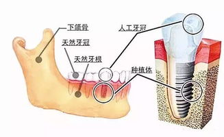 网友提问 做种植牙会影响 核磁共振 检查吗