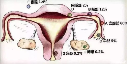 宫外孕征兆(宫外孕有什么症状)