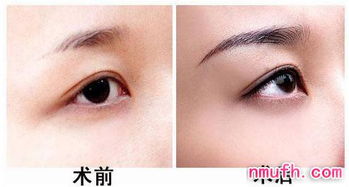 南京哪些人比较适合做眉毛种植