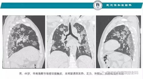 热成像技术：可检测肺燥热，助您保持健康！