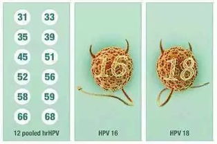 放大招 HPV用类似于口腔溃疡的中医治疗就能转阴 