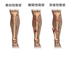 小腿骨折毕业论文