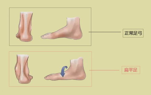 当心 久站脚痛 走路内八,都是扁平足在作怪