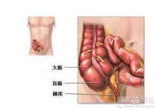 慢性阑尾炎不想动手术吃什么药好