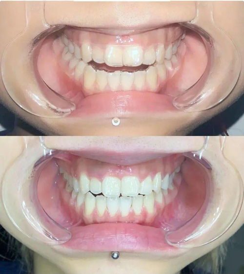 惊喜 3张牙齿照片就能获得牙齿矫正方案,1W多的牙套在家完成矫正