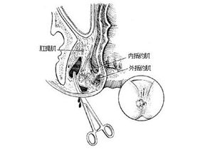 肛裂手术原理图解图片