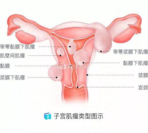 子宫肌瘤是怎么引起的 大多与这五个原因有关,女性要注意预防