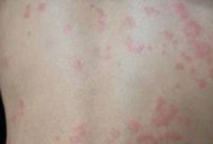 身上长荨麻疹的原因是什么