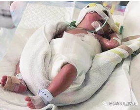 媒体报道 早产女婴重一斤半从齐市送哈急救 医生一路看 脸色 调整呼吸机目前生命体征正常