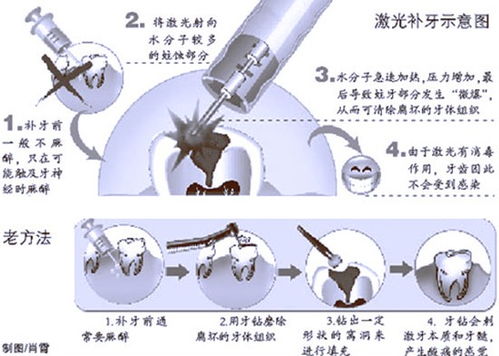 激光补牙效果